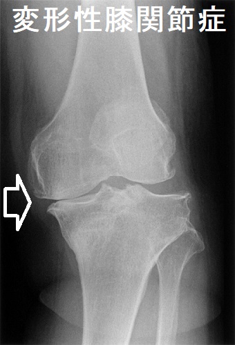 甲状腺と整形外科[変形性膝関節症・股関節症・アキレス腱断裂