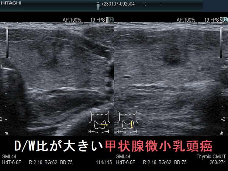 DW比が大きい甲状腺微小乳頭癌(拡大) DW比が大きい甲状腺微小乳頭癌(拡大)