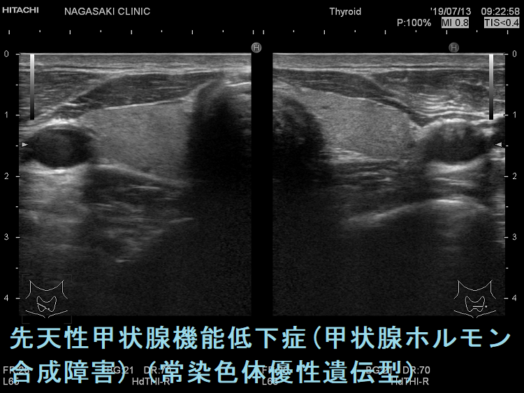 先天性甲状腺機能低下症(甲状腺ホルモン合成障害)(常染色体優性遺伝型) 超音波(エコー)画像 先天性甲状腺機能低下症(甲状腺ホルモン合成障害)(常染色体優性遺伝型) 超音波(エコー)画像