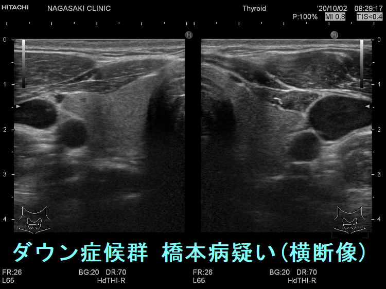 ダウン症候群 橋本病疑い 超音波(エコー)画像(横断像) ダウン症候群 橋本病疑い 超音波(エコー)画像(横断像)