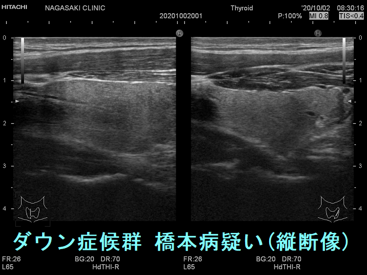 ダウン症候群 橋本病疑い 超音波(エコー)画像(縦断像) ダウン症候群 橋本病疑い 超音波(エコー)画像(縦断像)
