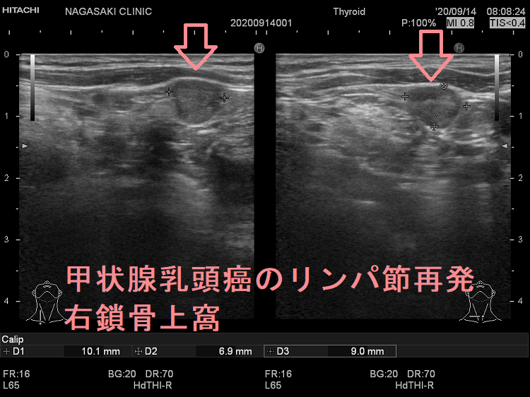 甲状腺乳頭癌のリンパ節再発 右鎖骨上窩 超音波(エコー)画像 甲状腺乳頭癌のリンパ節再発 右鎖骨上窩 超音波(エコー)画像