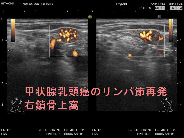 甲状腺乳頭癌のリンパ節再発 右鎖骨上窩 超音波(エコー)画像 ドプラーモード 甲状腺乳頭癌のリンパ節再発 右鎖骨上窩 超音波(エコー)画像 ドプラーモード