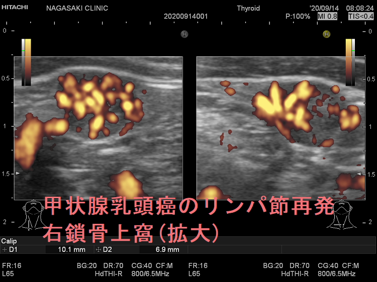 甲状腺乳頭癌のリンパ節再発 右鎖骨上窩 超音波(エコー)画像 ドプラーモード(拡大) 甲状腺乳頭癌のリンパ節再発 右鎖骨上窩 超音波(エコー)画像 ドプラーモード(拡大)