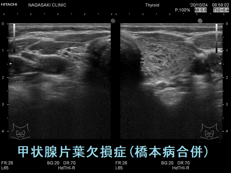 甲状腺片葉欠損症(橋本病合併) 甲状腺片葉欠損症(橋本病合併)