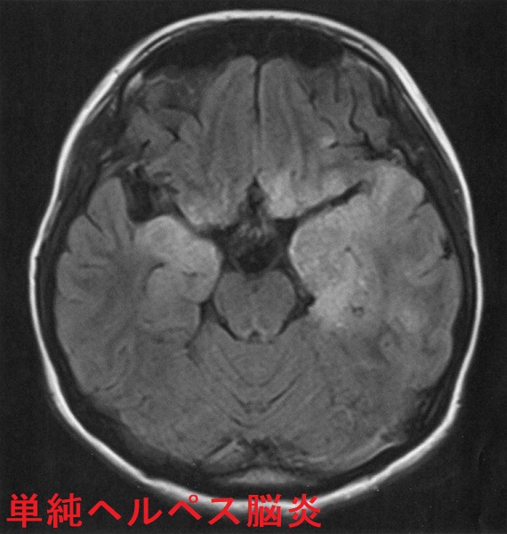 単純ヘルペス脳炎 頭部単純MRI のFLAIR 像 単純ヘルペス脳炎 頭部単純MRI のFLAIR 像