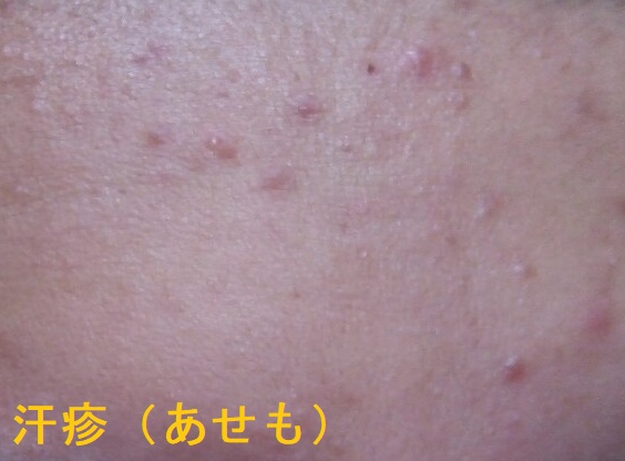 汗疹(あせも) 汗疹(あせも)