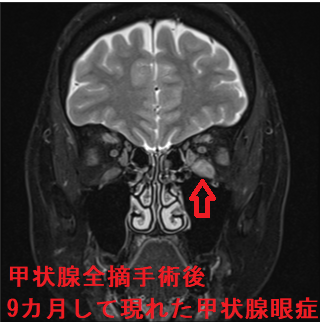 甲状腺全摘手術後9カ月して現れた甲状腺眼症 甲状腺全摘手術後9カ月して現れた甲状腺眼症