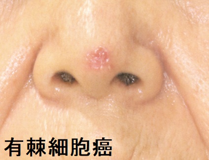 有棘細胞癌 有棘細胞癌