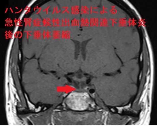 ハンタウイルス感染による急性腎症候性出血熱関連下垂体炎後の下垂体萎縮 ハンタウイルス感染による急性腎症候性出血熱関連下垂体炎後の下垂体萎縮