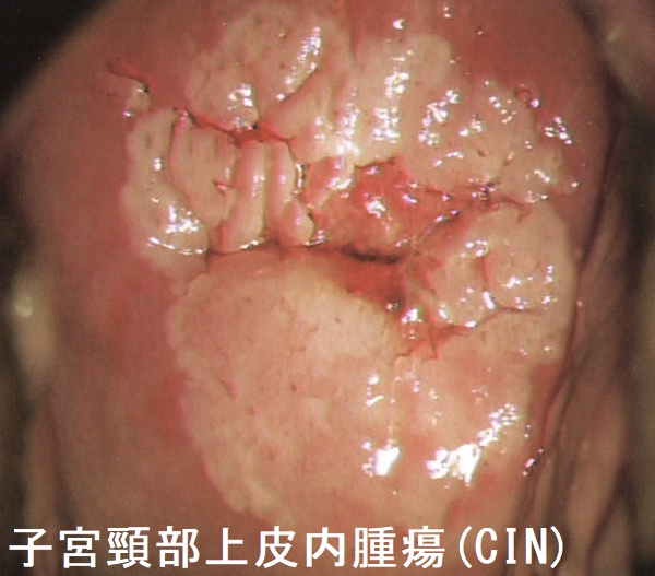 子宮頸部上皮内腫瘍(CIN) 子宮頸部上皮内腫瘍(CIN)