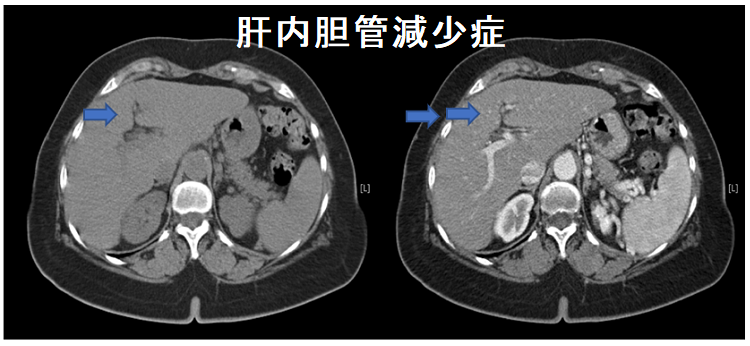 成人の肝内胆管減少症 成人の肝内胆管減少症