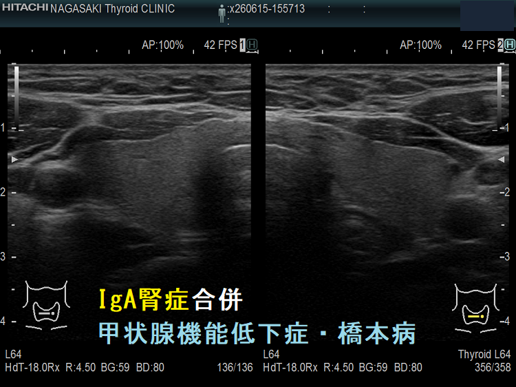 IgA腎症合併 甲状腺機能低下症・橋本病(水平断) 超音波(エコー)画像 IgA腎症合併 甲状腺機能低下症・橋本病(水平断) 超音波(エコー)画像