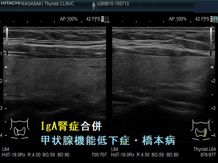 IgA腎症合併 甲状腺機能低下症・橋本病(矢状断) 超音波(エコー)画像 IgA腎症合併 甲状腺機能低下症・橋本病(矢状断) 超音波(エコー)画像