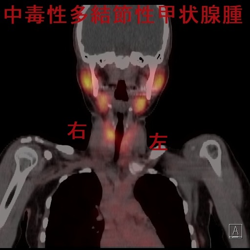 中毒性多結節性甲状腺腫(TMNG) 99mTCシンチグラフィー(冠状断) 中毒性多結節性甲状腺腫(TMNG) 99mTCシンチグラフィー(冠状断)