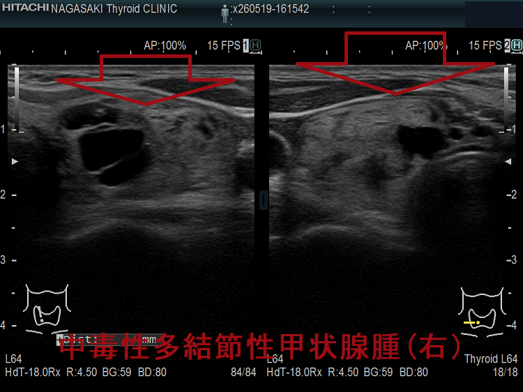中毒性多結節性甲状腺腫(TMNG) 超音波(エコー)画像(右) 中毒性多結節性甲状腺腫(TMNG) 超音波(エコー)画像(右)