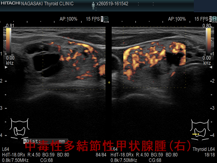 中毒性多結節性甲状腺腫(TMNG) 超音波(エコー)画像(右)ドプラーモード 中毒性多結節性甲状腺腫(TMNG) 超音波(エコー)画像(右)ドプラーモード
