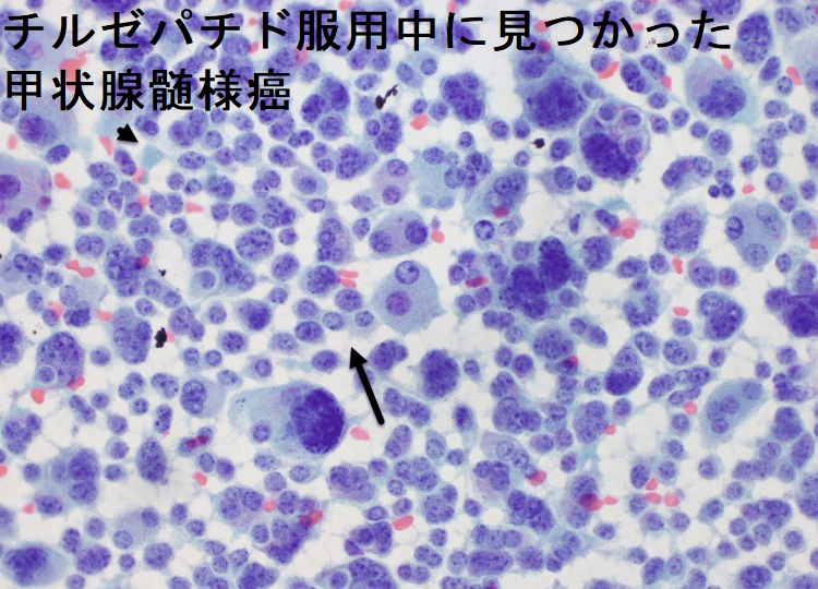 チルゼパチド服用中に見つかった甲状腺髄様癌 組織像 チルゼパチド服用中に見つかった甲状腺髄様癌 組織像