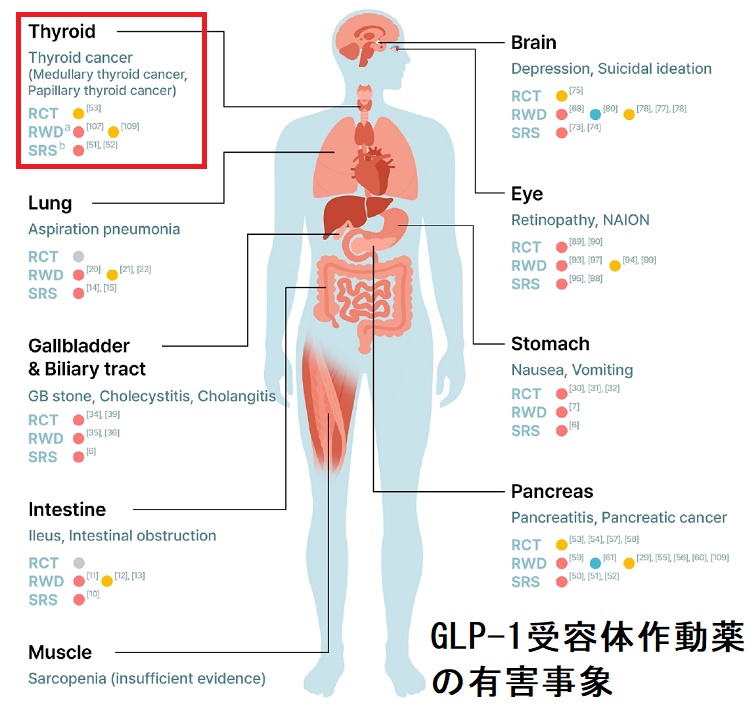 肥満治療薬・糖尿病治療薬のGLP-1受容体作動薬(リラグルチド,チルゼパチド,セマグルチド)で甲状腺癌,甲状腺髄様癌,甲状腺炎に