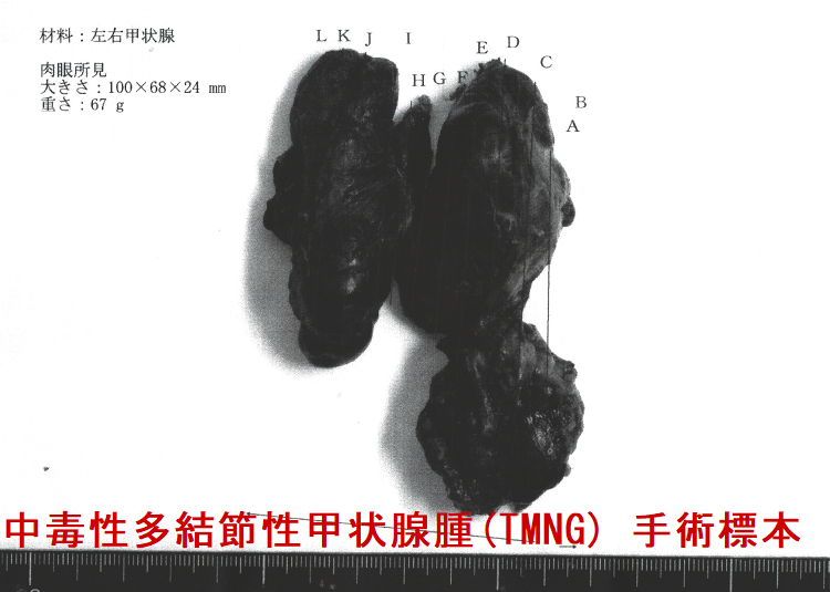 中毒性多結節性甲状腺腫(TMNG) 手術標本(表) 中毒性多結節性甲状腺腫(TMNG) 手術標本(表)