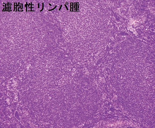 濾胞性リンパ腫 リンパ節生検組織H-E 染色標本 濾胞性リンパ腫 リンパ節生検組織H-E 染色標本