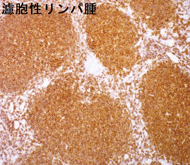 濾胞性リンパ腫 リンパ節生検組織CD20 免疫組織化学染色標本 濾胞性リンパ腫 リンパ節生検組織CD20 免疫組織化学染色標本