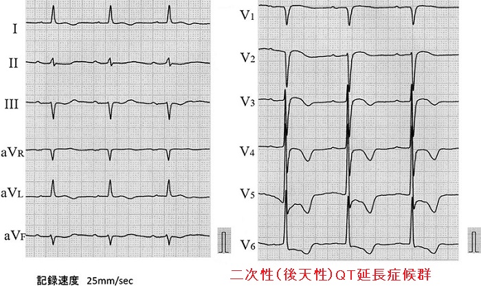 二次性(後天性)QT延長症候群の心電図 二次性(後天性)QT延長症候群の心電図