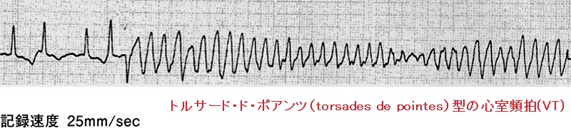 トルサード・ド・ポワンツ(torsades de pointes)の心電図 トルサード・ド・ポワンツ(torsades de pointes)の心電図