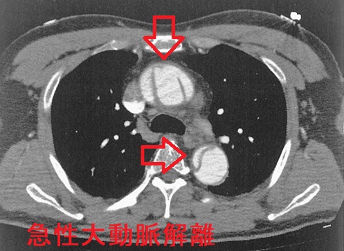 急性大動脈解離 造影CT画像 急性大動脈解離 造影CT画像