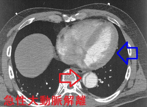 急性大動脈解離 造影CT画像 急性大動脈解離 造影CT画像