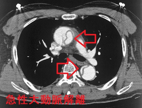 急性大動脈解離 造影CT画像 急性大動脈解離 造影CT画像
