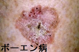 ボーエン病 ボーエン病