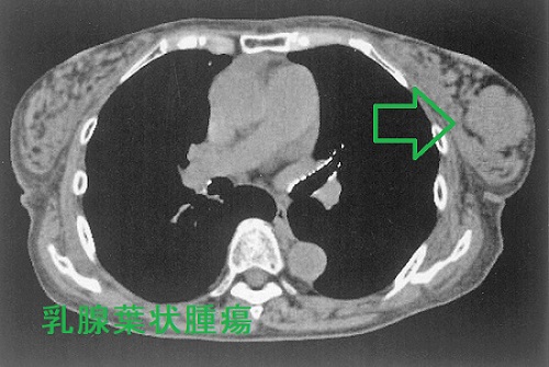 乳腺葉状腫瘍 CT画像 乳腺葉状腫瘍 CT画像