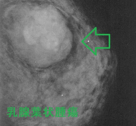 乳腺葉状腫瘍 マンモグラフィー 乳腺葉状腫瘍 マンモグラフィー