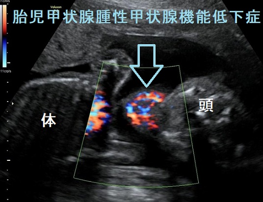 胎児甲状腺腫性甲状腺機能低下症 胎児甲状腺腫性甲状腺機能低下症