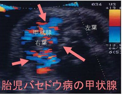 胎児バセドウ病の甲状腺 超音波(エコー)画像 胎児バセドウ病の甲状腺 超音波(エコー)画像