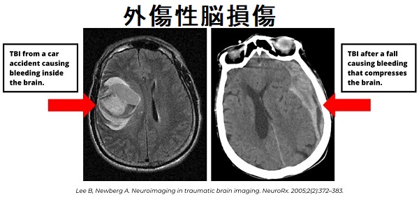 てんかん,てんかん薬(カルバマゼピン等)と甲状腺[甲状腺機能低下