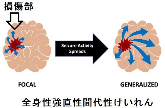 全身性強直性間代性けいれん 全身性強直性間代性けいれん