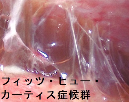 フィッツ・ヒュー・カーティス症候群(腹腔鏡) フィッツ・ヒュー・カーティス症候群(腹腔鏡)