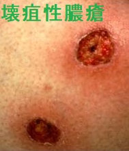 無顆粒球症と緑膿菌感染 無顆粒球症と緑膿菌感染