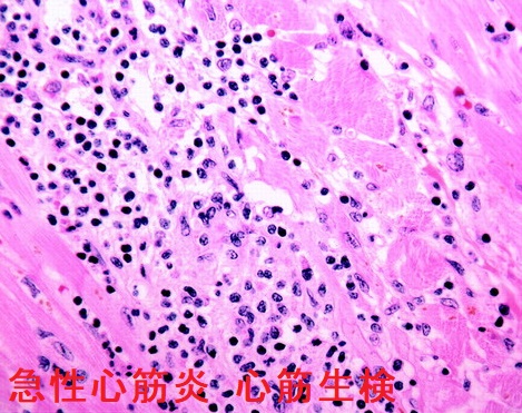 急性心筋炎 心筋生検 急性心筋炎 心筋生検