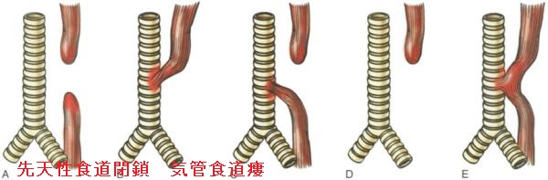 気管食道瘻 気管食道瘻