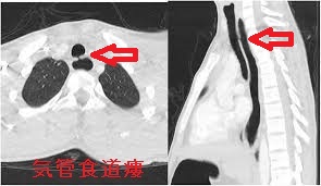 気管食道瘻 CT画像 気管食道瘻 CT画像