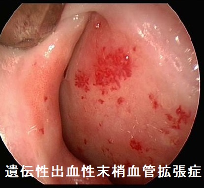 遺伝性出血性末梢血管拡張症 鼻腔粘膜 遺伝性出血性末梢血管拡張症 鼻腔粘膜