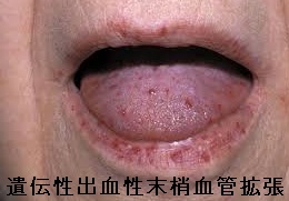 遺伝性出血性末梢血管拡張症 口腔内出血 遺伝性出血性末梢血管拡張症 口腔内出血