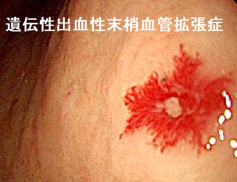 遺伝性出血性末梢血管拡張症 消化管出血 遺伝性出血性末梢血管拡張症 消化管出血