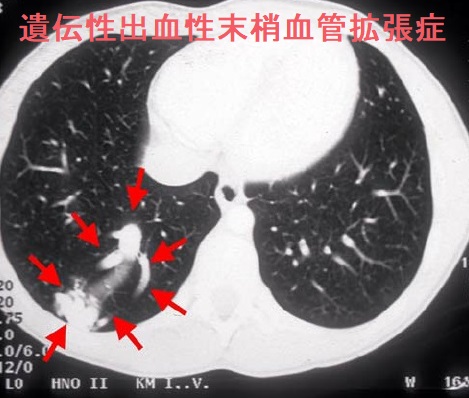 遺伝性出血性末梢血管拡張症 肺動静脈奇形 遺伝性出血性末梢血管拡張症 肺動静脈奇形