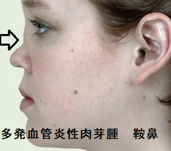 多発血管炎性肉芽腫 鞍鼻 多発血管炎性肉芽腫 鞍鼻