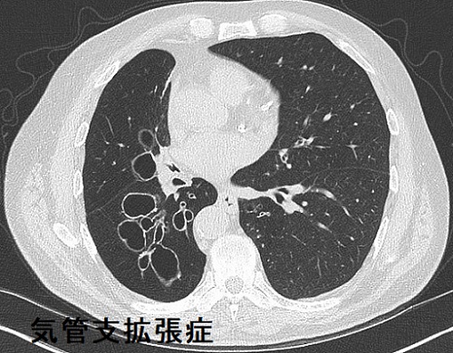 気管支拡張症 CT 気管支拡張症 CT