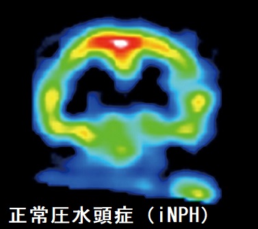 正常圧水頭症(iNPH)SPECT 正常圧水頭症(iNPH)SPECT